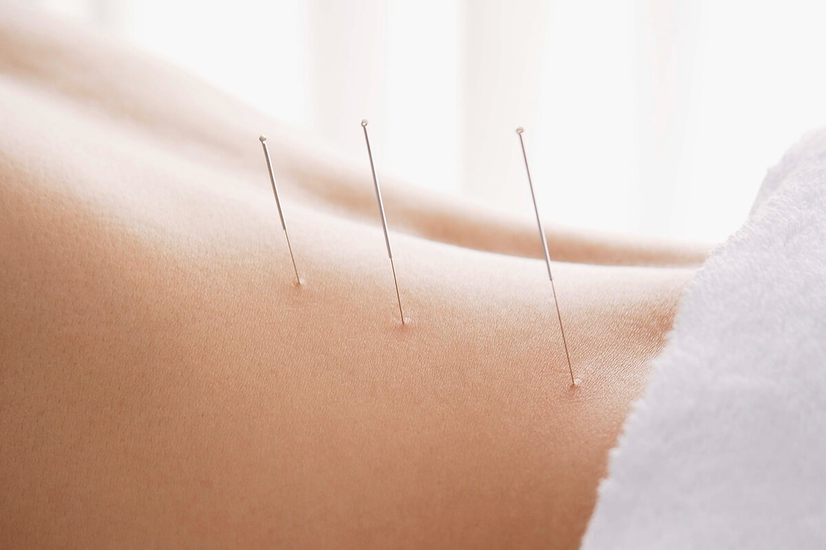 close up of acupuncture needles placed in a person's back