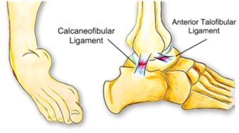Ankle Instability – Diagnosis and Management of Acute and Chronic